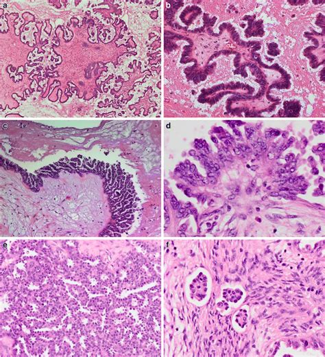 Ovarian Borderline Tumors In The 2014 Who Classification Evolving