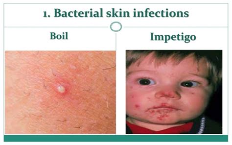 Skin Infections Ppt