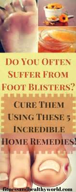 Do You Often Suffer From Foot Blisters Cure Them Using These 5