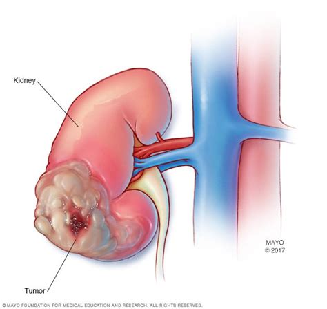 What causes kidney cancer (renal cell cancer)? Kidney cancer Disease Reference Guide - Drugs.com