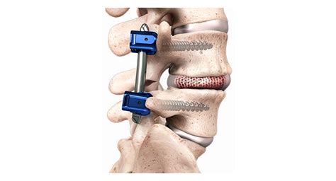 Spineology Us Clinical Trial For Interbody Fusion Orthospinenews