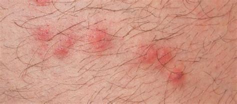 What Do Flea Bites Look Like Get Rid Of Fleas Orkin