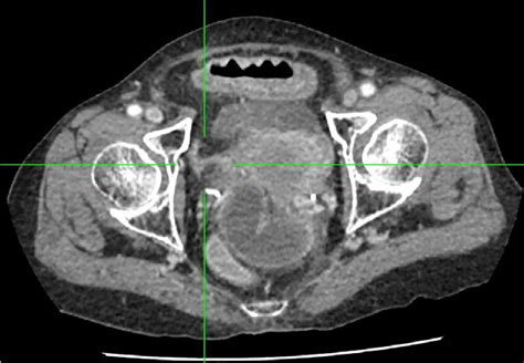Figure 1 From An Unusual Case Of Early Stage Obturator Hernia Causing