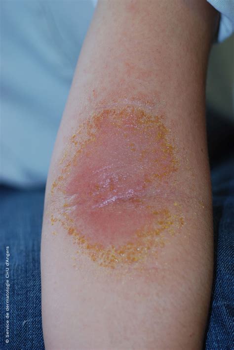 Eczema On The Arms Eczema Foundation