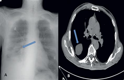 Figure From Phantom Tumor Of The Lung In A Patient With Preserved