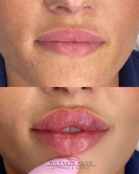 Take A Look At This Before And After Lip Filler How Fabulous These