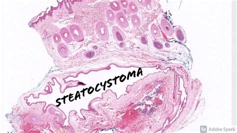 Steatocystoma Multiplex Histology