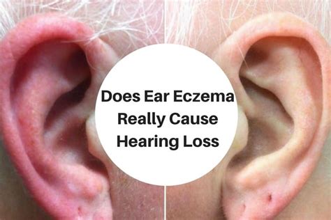 Eczema In Ears Does It Really Cause Hearing Loss