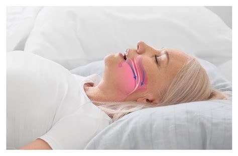 Understanding The Different Types Of Oral Appliances That Treat Your