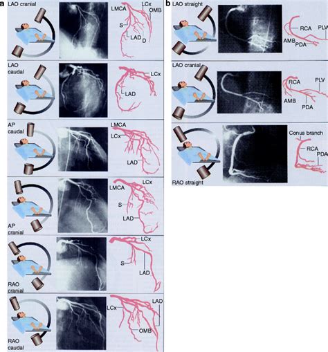 Invasive Coronary Angiography Radiology Key