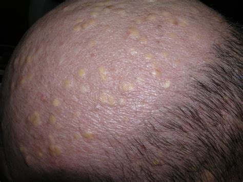 Cysts On Scalp Pictures Photos