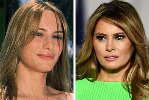 Unrecognizable Melania Trump The Before And After Cosmetic Surgery Is