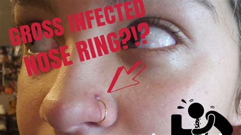 Quick And Easy Way To Cure An Infected Nose Ring Youtube