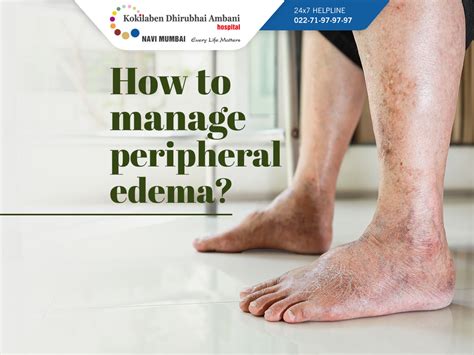 How To Manage Peripheral Edema