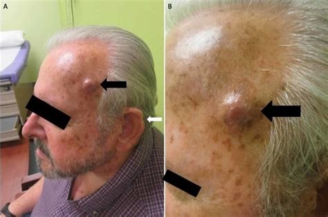 Cureus Metastatic Squamous Cell Carcinoma A Cautionary Tale