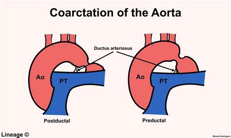 Coarctation Of The Aorta Cardiovascular Medbullets Step 1