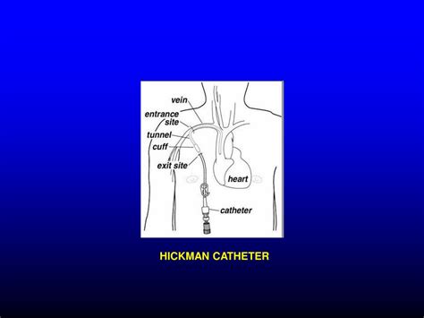 Ppt Hickman Catheter Powerpoint Presentation Free Download Id9277930