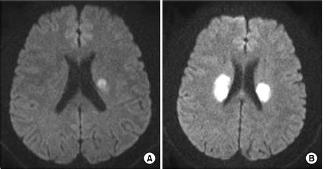 Figure From Early Recurrent Right Basal Ganglia Infarction After