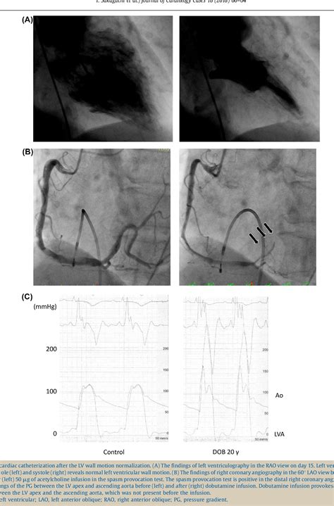 Figure 3 From Dynamic Left Ventricular Outflow Tract Obstruction