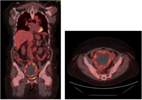 Pet Ct Of Uterine Pecoma Illustrating A Large Centrally Necrotic