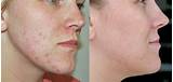 Pictures of Acne Marks Treatment At Home