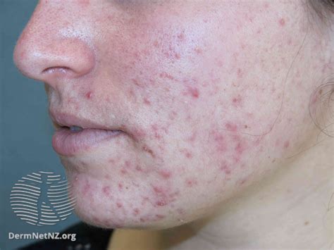 Overview Of The Types And Stages Of Acne