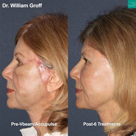 Scar And Acne Scar Treatment Med Spa San Diego Ca Clderm