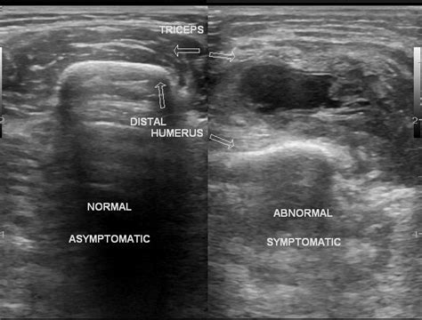 Partial Rupture Of Triceps Muscle Image