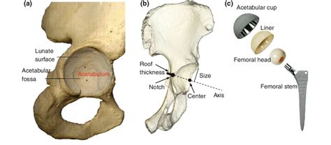 A Morphological Detail Of The Acetabulum In The Pelvic Bone The
