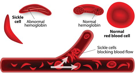 Care guide for sickle cell disease. How much do you know about sickle cell disease? - The ...