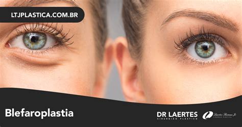 Blefaroplastia Cirurgia Plástica De Pálpebras Em São Paulo Dr