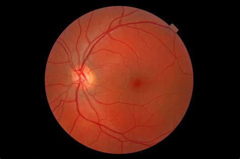Retinal Photography Information Barnett Opticians