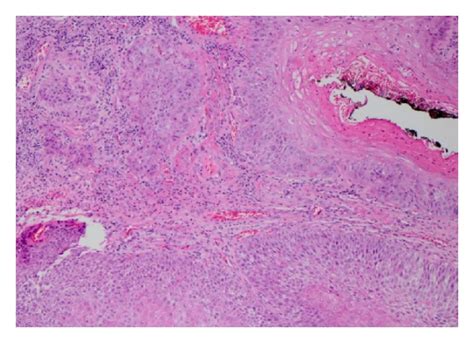 Figure 1 A 55 Year Old Man With Stage Iv Squamous Cell Carcinoma Of
