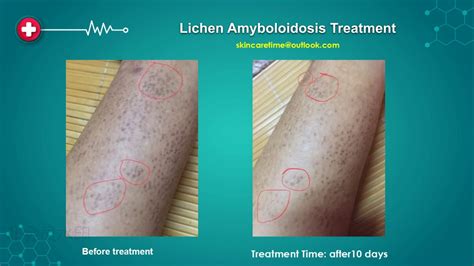 Successfull Lichen Amyloidosis Treatment Lichen Amyloidosis Cure 2019