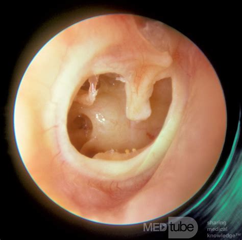 Subtotal Perforation Right Ear Picture