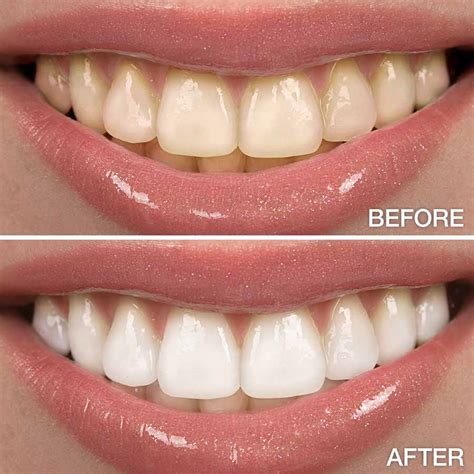 Teeth Whitening Kelvin B Smith Dds Llc Baltimore Maryland