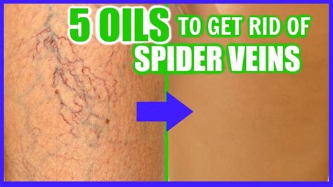 Essential Oil For Varicose Veins Renew Physical Therapy