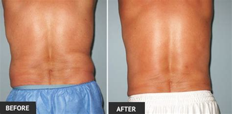 Real Patient Liposuction Before And After Photos By Dr Wright Laser