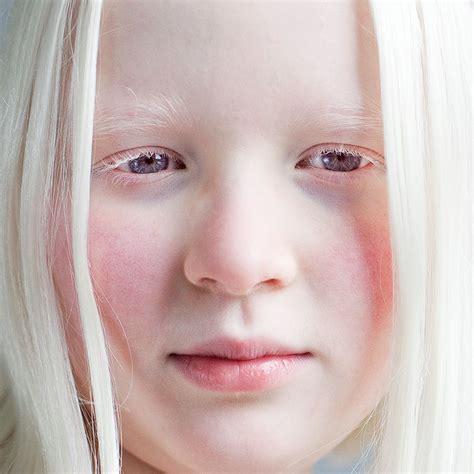 Alles Was Du Ber Albinismus Wissen Musst Demedbook