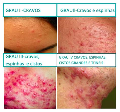 Total 50 imagem diferença entre acne espinha e cravo br thptnganamst