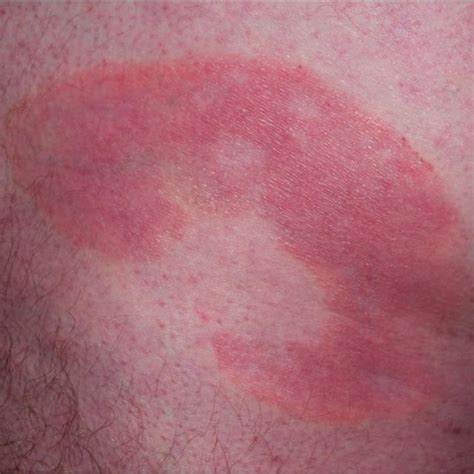 Folliculotropic Mycosis Fungoides Erythematous Plaques With Follicular