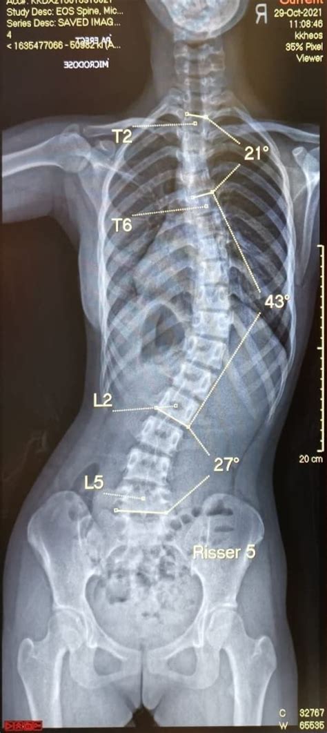 Curved Spine Scoliosis What You May Want To Know