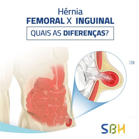 Hérnia Femoral x Inguinal quais as diferenças SBH