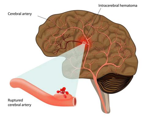 Intracerebral Hemorrhage Altair Health