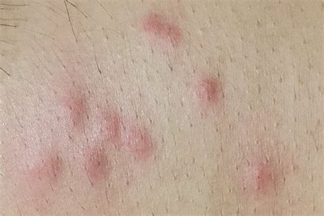 Bed Bug Bites On Face And Neck