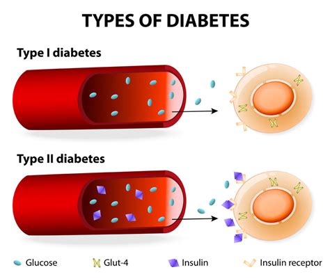 Types Of Diabetes Type 1 Type 2 And Gestational Diabetes
