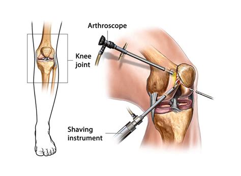 ACL Reconstruction OrthoSport Victoria