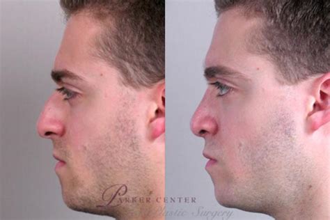 Rhinoplasty Before And After Pictures Case 138 Paramus Nj Parker