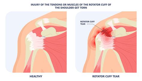 Rotator Cuff Tear Motus Physical Therapy