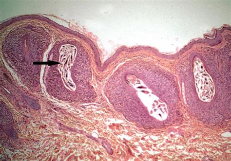Demodex Mites In Follicles